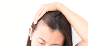 hair loss is a common PCOS question