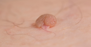 Skin tags is a common PCOS symptom