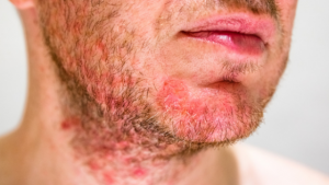 Man's face with razor burn