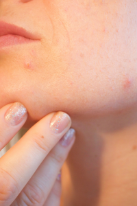 Woman's jawline with acne