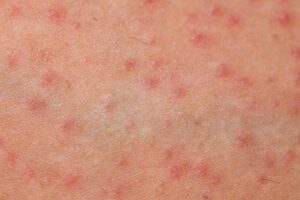Folliculitis: Causes, Symptoms, Treatment and Prevention