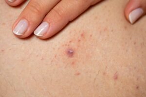 Is There a Cure for Folliculitis?