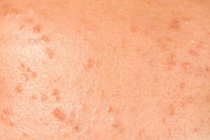 Pityrosporum Folliculitis: Causes, Symptoms, Treatments and Prevention