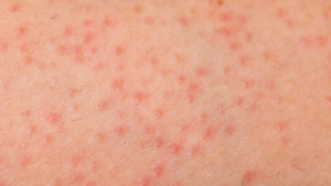 close of image of folliculitis