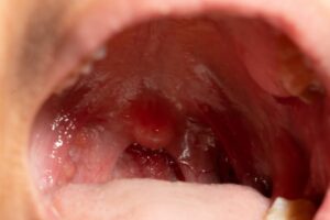 Tonsil Cancer: Signs, Symptoms and Treatment