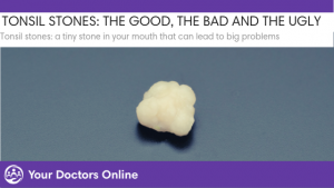 tonsil stones