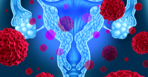 what is pcos