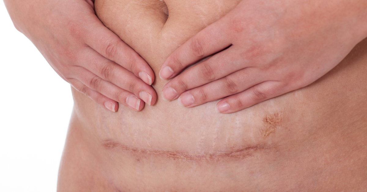 Ask a doctor pain after c-section