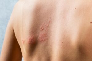 I Got Rid Of Shingles, Thanks To Your Doctors Online!