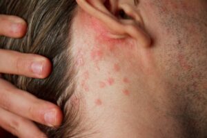 Your Doctors Online Treated My Heat Rash!