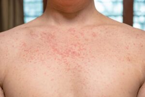 How Long Does it Take to Cure Syphilis? Causes and Treatment