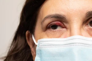 How to treat stye