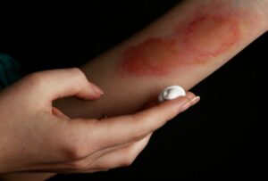 First and Second degree burn