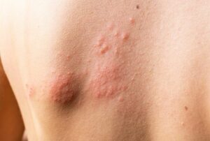 Hives Treatment and Causes