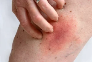 Allergic reaction on a woman's leg