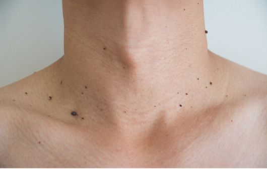 Genital Warts Treatment Online