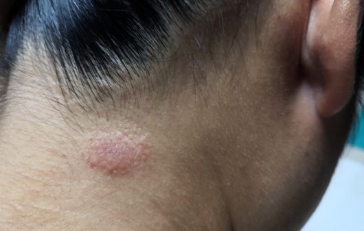 Get Ringworm Treatment Online and Prescription