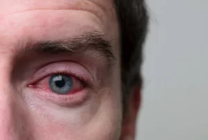 severe-chlamydia-in-eye-infection