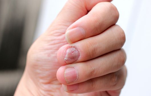 Green nail syndrome on the nail plate and bed related with Enterococcus and  Fusarium coinfection