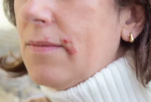 herpes on the lips, part of a woman's face with finger on lips with herpes, beauty concept