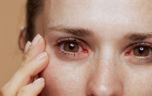 Pink eye: What it is and how to treat it