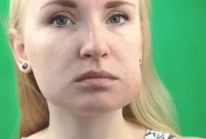 women with Parotid Gland Swelling