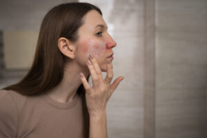 Hyperpigmentation (Discoloration) around the mouth