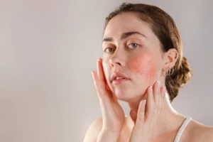 metronidazole for rosacea