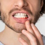 amoxicillin for tooth infection