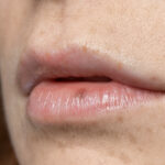 small bumps on lips no pain