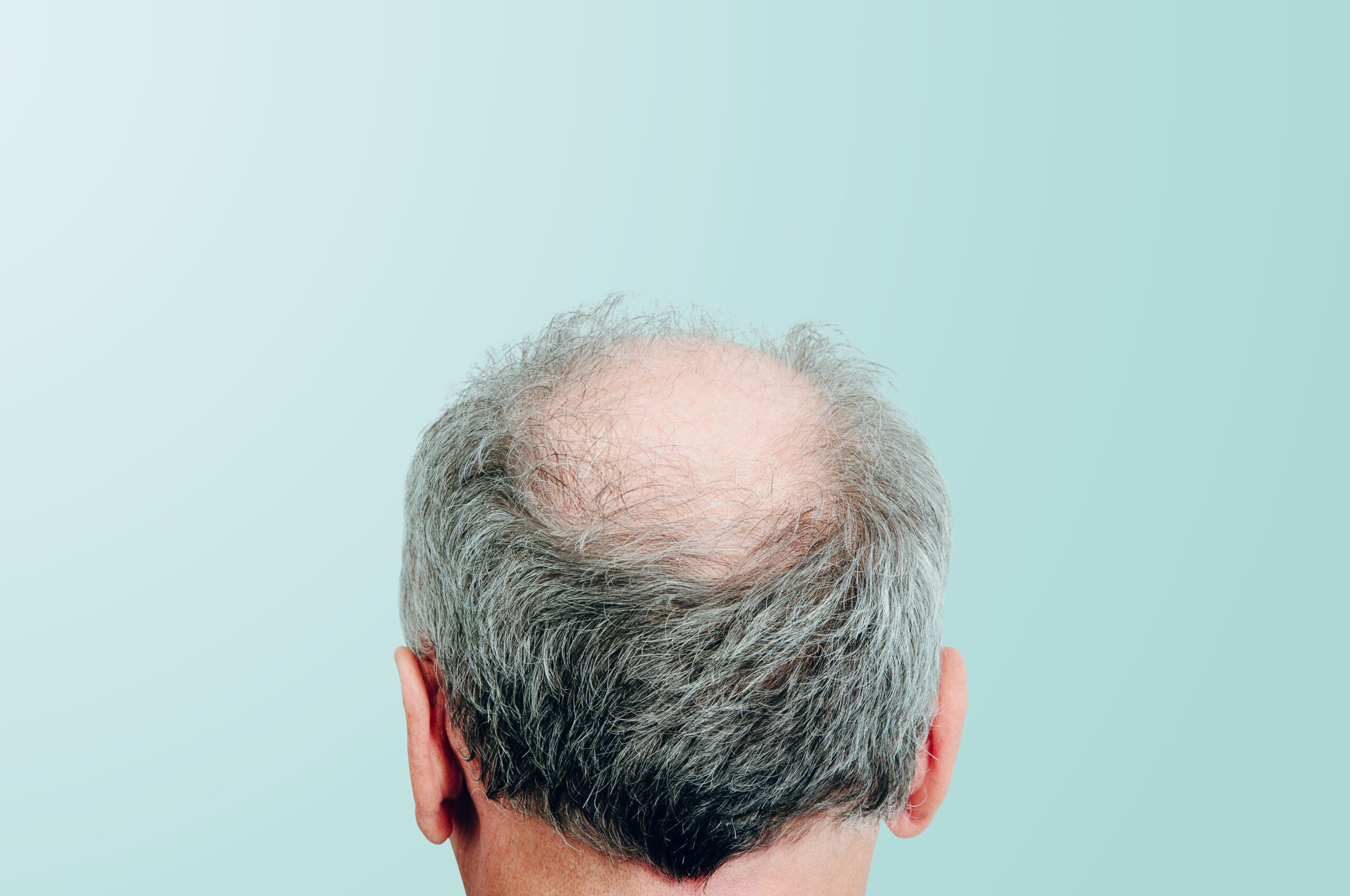 Rear view of a male head without hair on blue pastel background. Rear view of a male head without hair on blue pastel background. Hair loss concept, bird's nest on the head. Problems with hair regrowth, shampoo for facial hair growth.