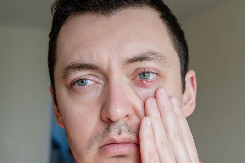 stye