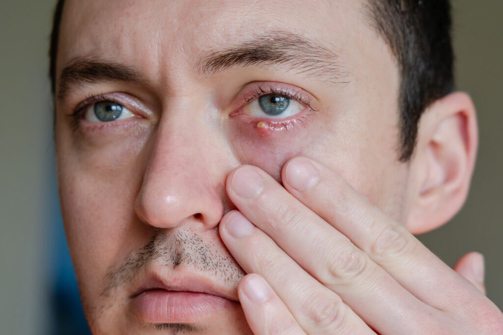Stye