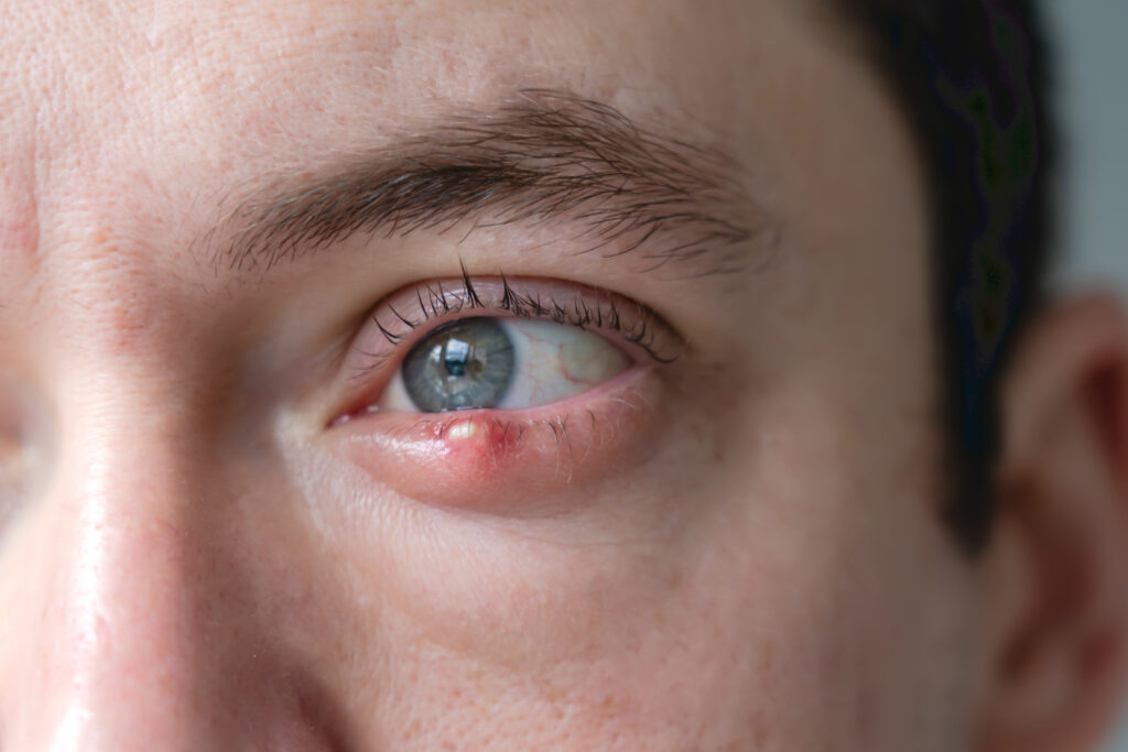 stye treatment
