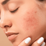 Doxycycline for acne is prescribed for moderate to severe breakouts.
