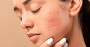 Doxycycline for acne is prescribed for moderate to severe breakouts.