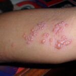 Herpes symptoms appear 2 to 12 days after exposure in most people, with an average of around 4 days.