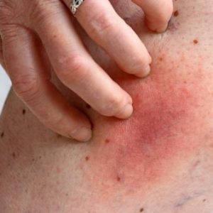 Cellulitis treatment online