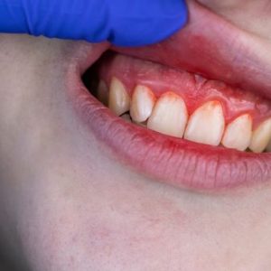 Dental infection Treatment Online