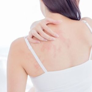 Eczema Treatment Online