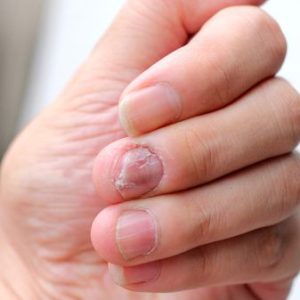 Nail Infections Treatment Online