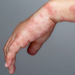 Shingles Treatment Online