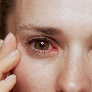 pink eye treatment Online